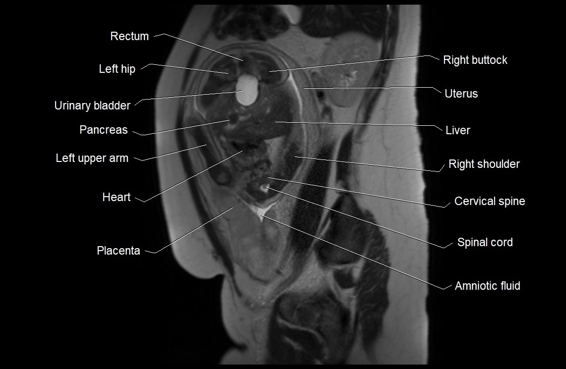 MRI fetal anatomy sagittal image 11.webp